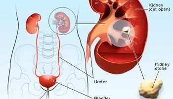 kidney stone