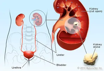 kidney stone