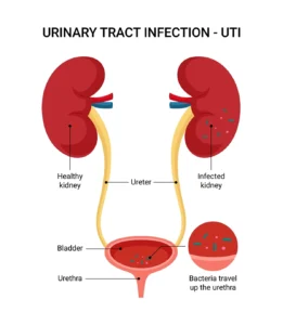 uti